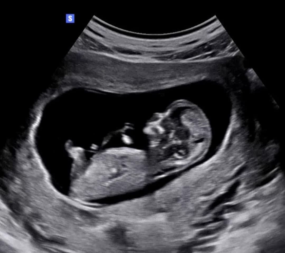 2D ultrasound session at 11 weeks pregnancy — Baby Studio 4D, Raleigh NC