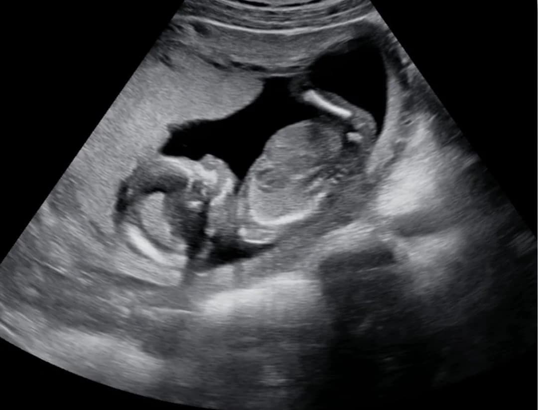 2D ultrasound session at 15 weeks pregnancy — Baby Studio 4D, Raleigh NC