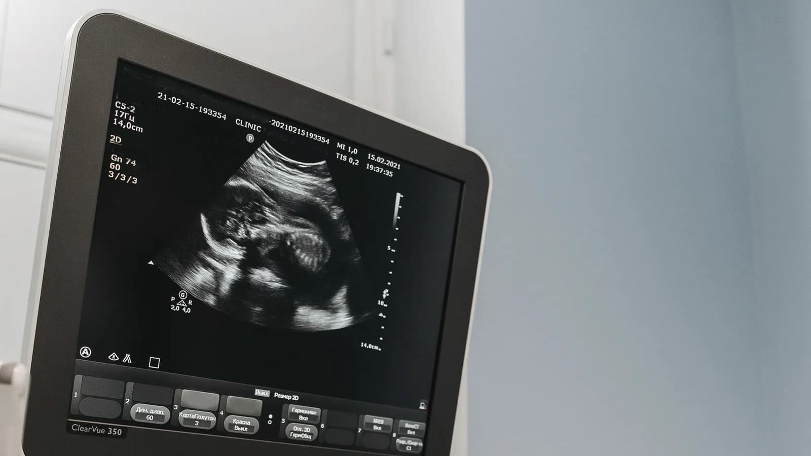 What is 8K ultrasound: Ultrasound machine screen displaying a detailed baby scan while a hand adjusts the controls