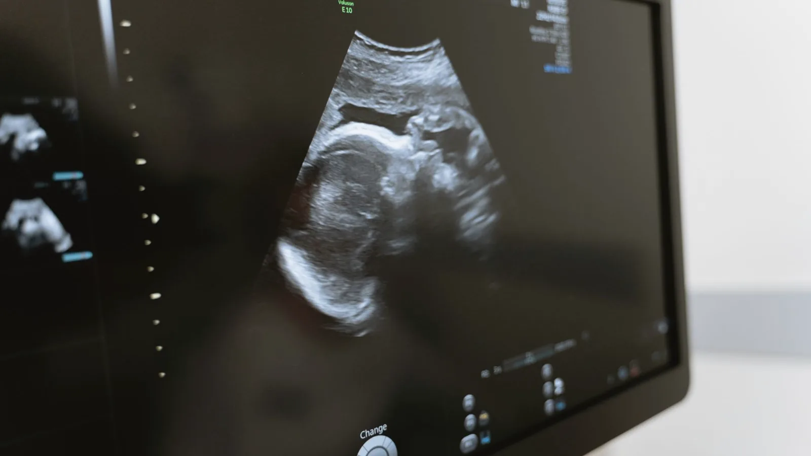 How 3D 4D ultrasound works: Ultrasound monitor showing a baby profile scan in a bright clinic